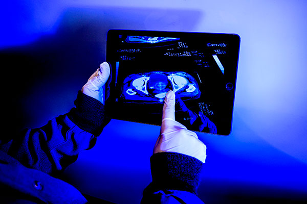 Detecting Prostate Cancer Faster With AI